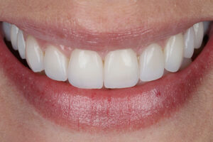 Leia mais sobre o artigo Antes e Depois de Lentes de Contato Dental em Porcelana