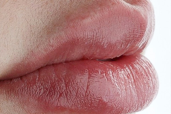 preenchimento labial