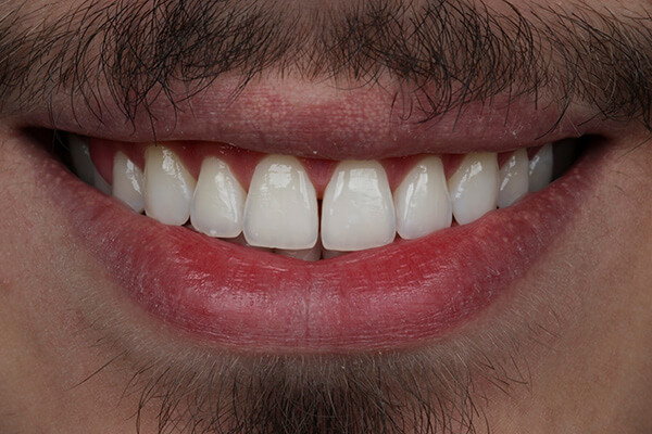 depois clareamento dental