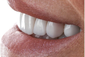 Leia mais sobre o artigo Plástica Gengival