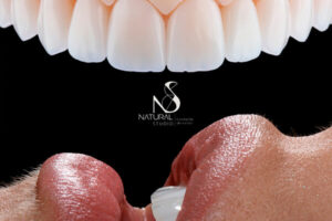 Leia mais sobre o artigo 8 Dicas importantes sobre Facetas de Porcelana