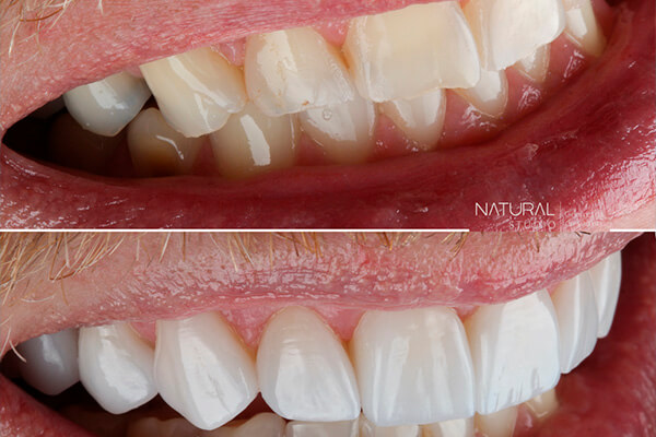 No momento, você está visualizando Esmalte do Dente: por que é importante conservá-lo?