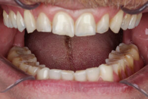 Leia mais sobre o artigo Você sofre de Bruxismo?