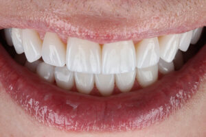 Leia mais sobre o artigo Desgaste Dental – Reabilitação com Lentes de Contato Dental