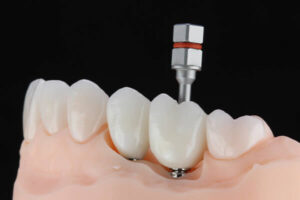 Leia mais sobre o artigo Prótese Sobre Implante: O que é e quando é utilizada?