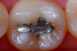 Leia mais sobre o artigo 5 Motivos para trocar as Restaurações Metálicas em Amálgama por Restaurações em Resina Composta.