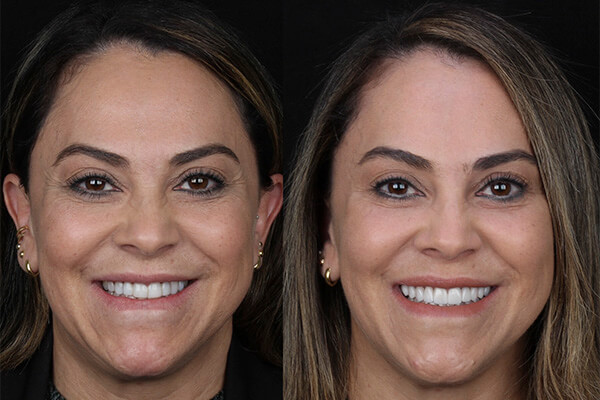 lentes de contato dental